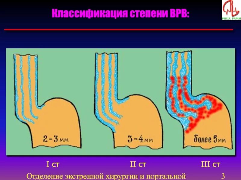 Лечение варикозного расширения пищевода