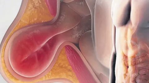 Hernias Abdominales - YouTube
