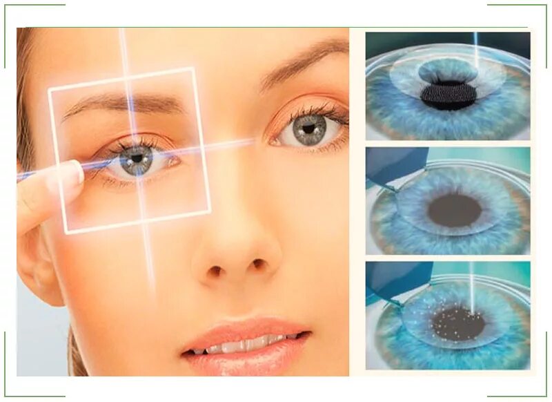 Лазерная операция на глаза. Лазерная операция на глаза астигматизм. Операция на глаза восстановление зрения