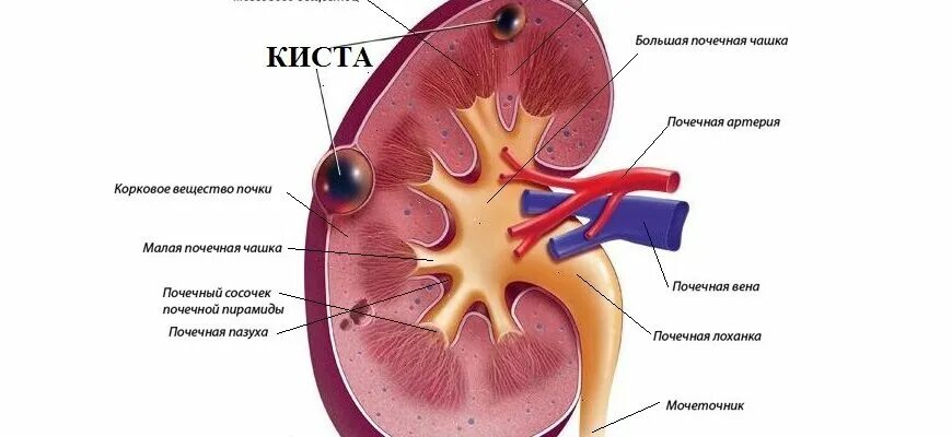 Паренхима почки что это. Парапельвикальные кисты. Почечная лоханка анатомия.