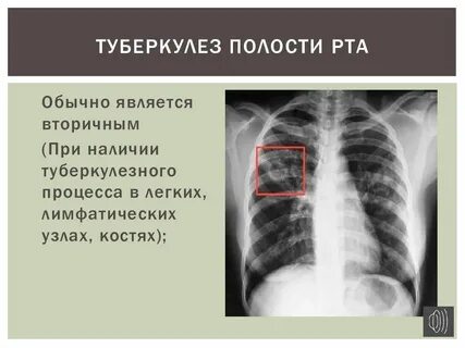Туберкулезная полость