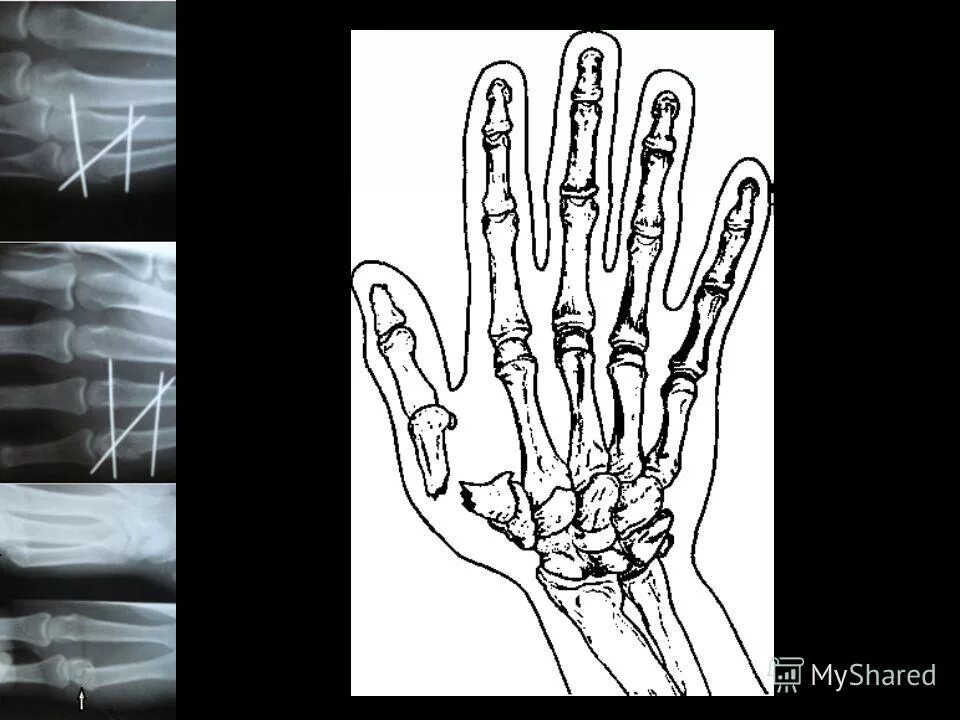 перелом ногтевой фаланги большого пальца руки. оскольчатый перелом фаланги пальца. перелом фаланги пальца лечение. перелом прокчимальной фплангм кичти. многооскольчатый перелом фаланги пальца.