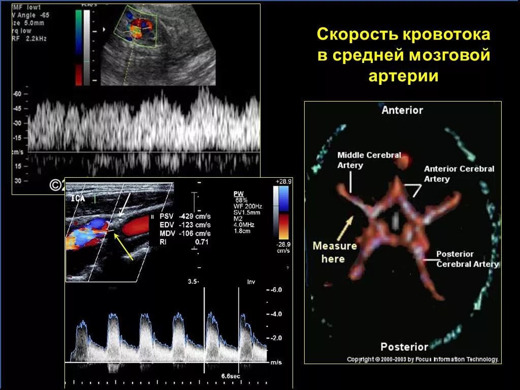 Сма плода. Средняя мозговая артерия плода допплер. Скорость кровотока в средней мозговой артерии плода. Допплерометрия средней мозговой артерии плода. Средняя мозговая артерия плода допплер норма.