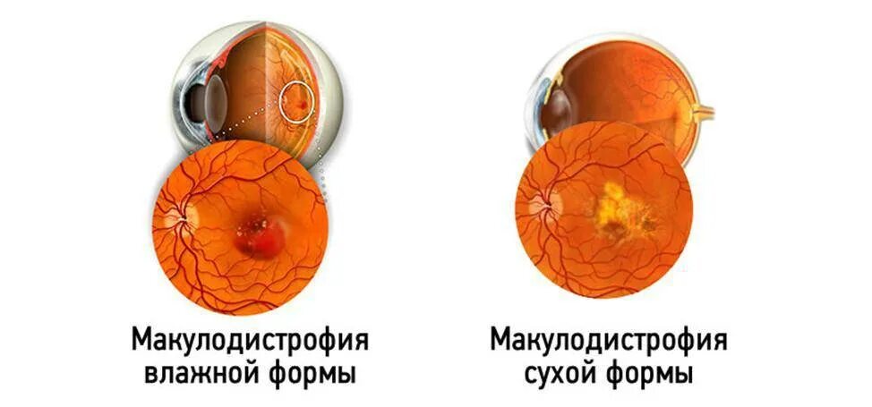 Лечение дегенерации макулы. Дистрофия макулы сетчатки. Возрастная макулодистрофия сухая форма. Макулодистрофия, макулярная дегенерация. Макулодистрофия, макулярная дегенерация; ретинит;.