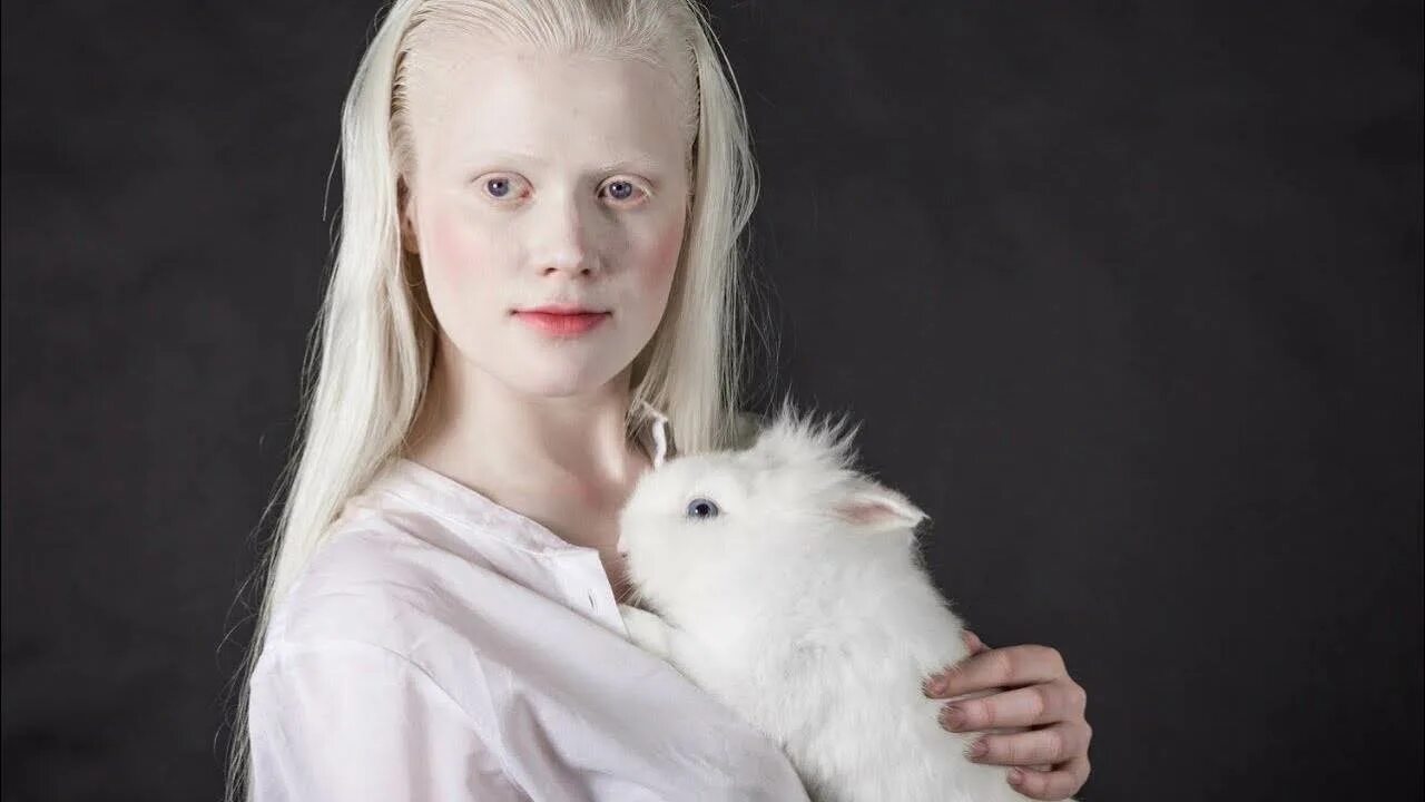 Страдающий альбинизмом