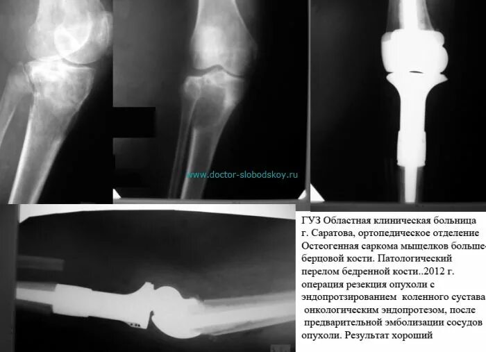 Остеосаркома тазобедренного сустава кт. Хондросаркома бедренной кости колена. Эндопротезирование большеберцовой кости. Остеосаркома бедренной кости. Эндопротез.