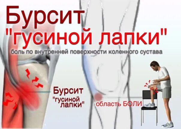 Тендинит гусиной лапки. Бурсит сумки гусиной лапки. Тендинит гусиной лапки узи коленного. Синдром гусиной лапки. Анзериновый бурсит коленного.