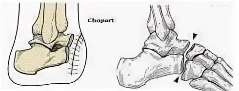 Сустав шопара и лисфранка анатомия. Ампутация стопы по шопару. Ампутация стопы по шарпу,лисфранку. Ампутация стопы по шарпу протокол. Экзартикуляция стопы по лисфранку и шопару.