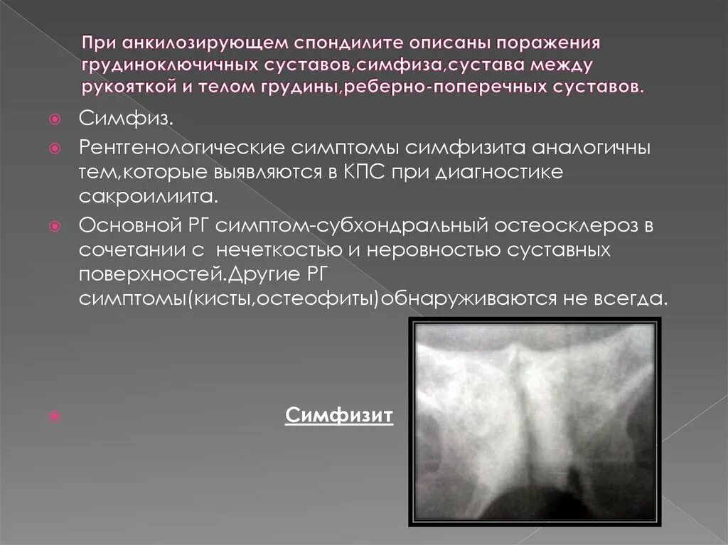Болезнь анкилозирующий спондилит. Анкилозирующий спондилит синдесмофиты. анкилозирующий спондилоартрит болезнь бехтерева. анкилозирующий спондилит протокол рентгена. рентгеносемиотика болезни бехтерева..