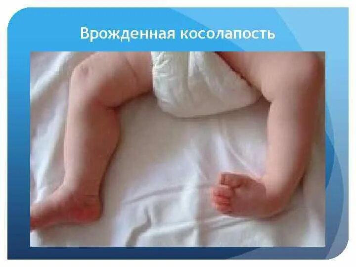 Отечность ног у грудничка. Эквиноварусная деформация стоп. Эквиноварусная косолапость. Косолапость пронаторы. Хондродистрофия, рахит.