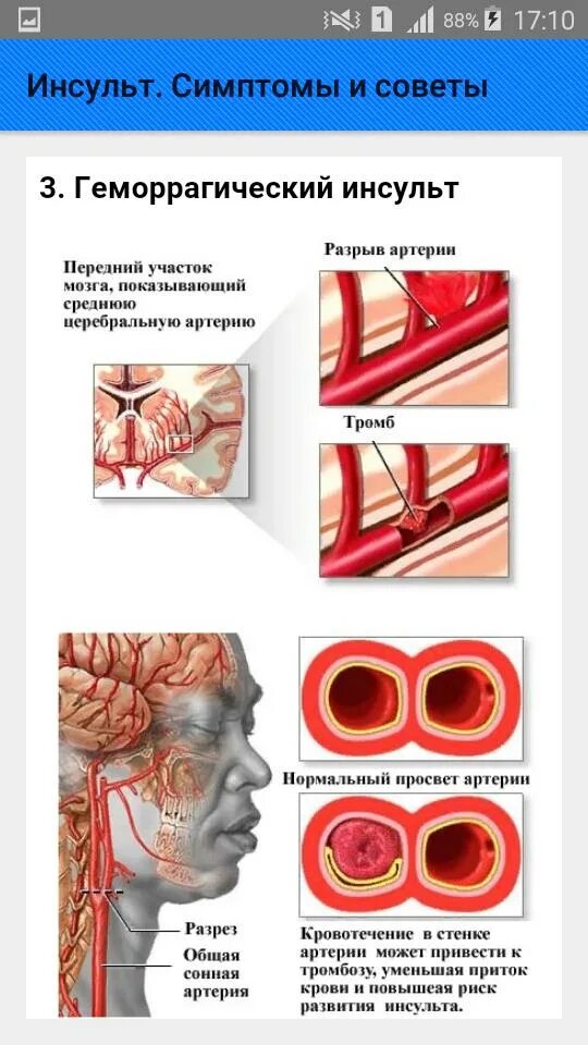 Как вызвать инсульт. Инсульт. Бессимптомный инсульт. Проявления инсульта. Признаки инсульта.