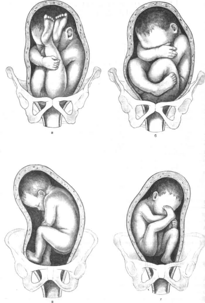 ребенок лежит в тазовом. тазовое предлежание плода. положение плода продольное предлежание тазовое. ягодичное предлежание плода роды. неправильное расположение плода.
