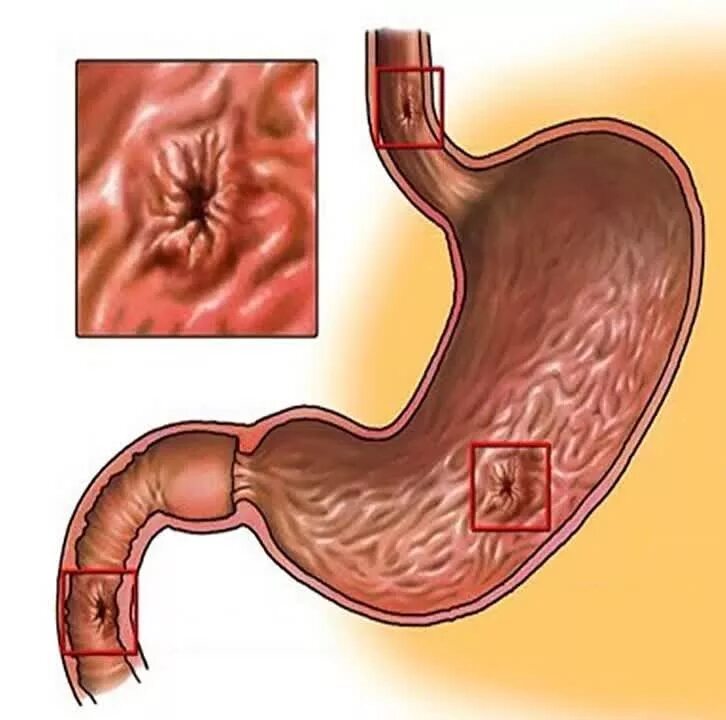 Язвенная болезнь желудка и 12 перстной кишки. Язва желудка и 12 перстной кишки. Прободная язва желудка и 12 перстной кишки. Перфорация язвы желудка и 12 перстной кишки. Как отличить язву