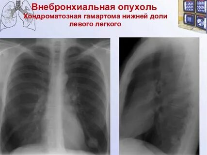 Объемное образование легкого