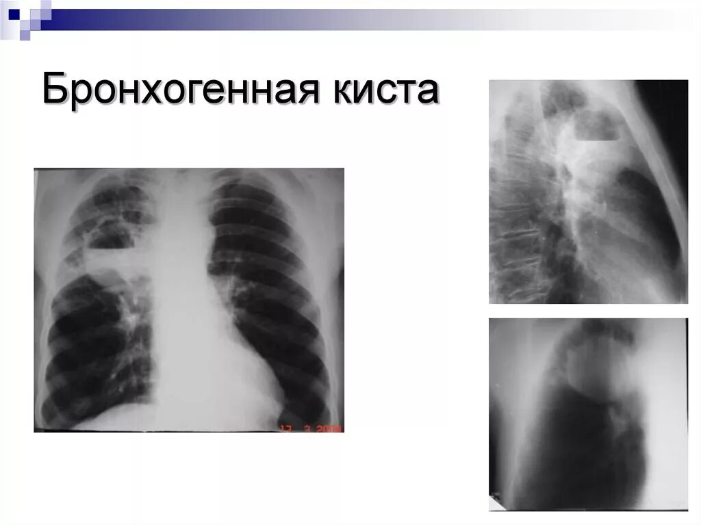 Солитарная киста легкого. Киста легких рентгенограмма. Бронхогенная киста легкого рентген. Бронхогенная киста рентген. Врожденные кисты легких.