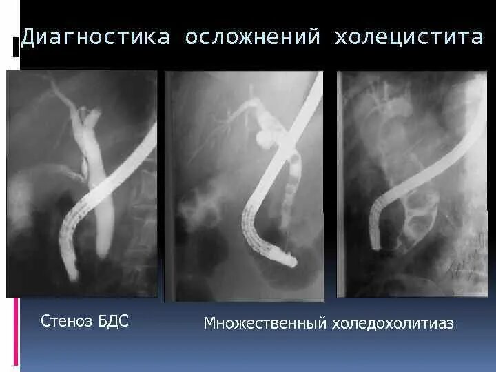 Стеноз кишечника что это. Стриктуры желчного протока ЭРХПГ. Стеноз фатерова сосочка. Стриктуры желчного протока УЗИ.