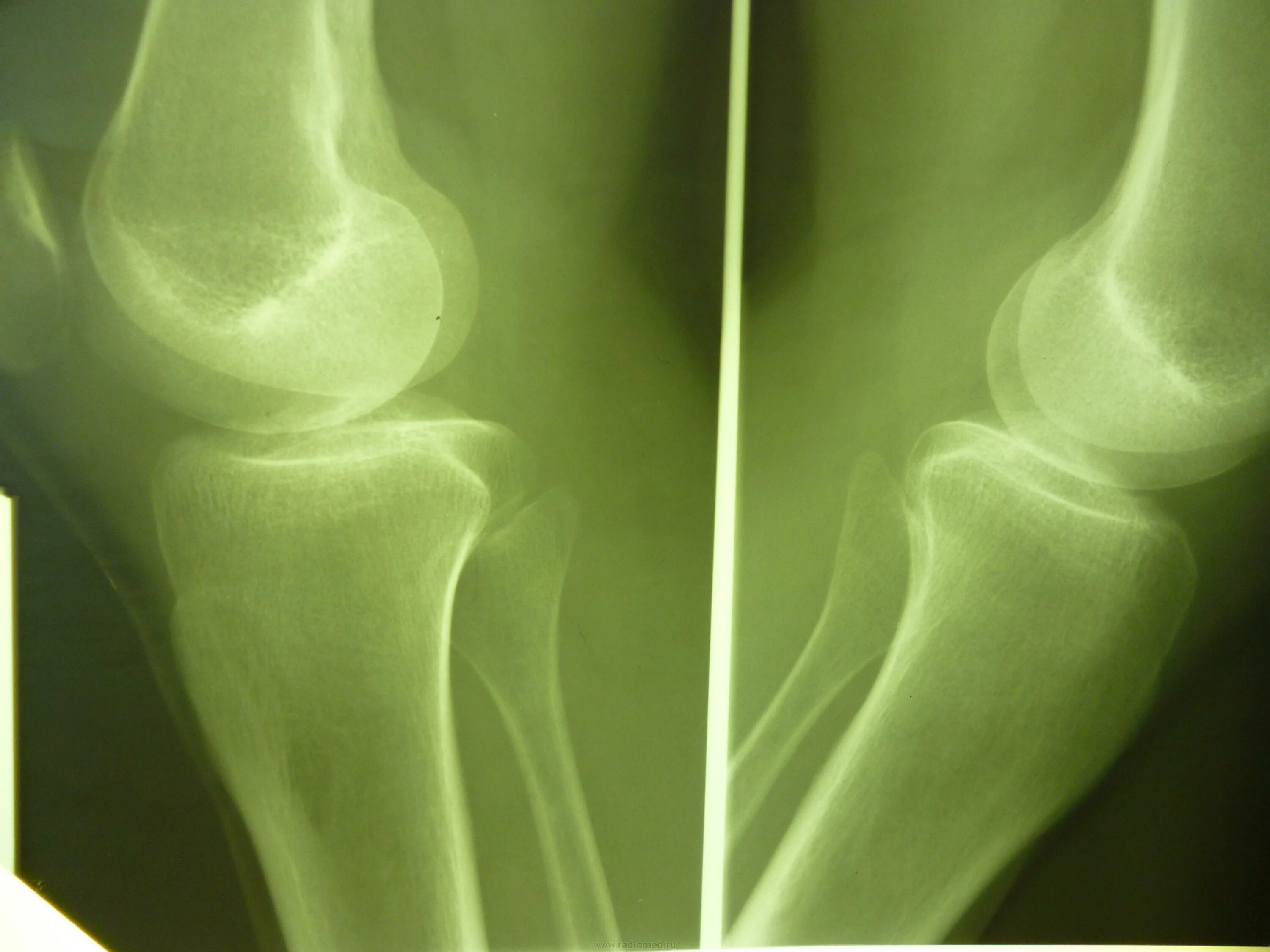 Разряжение костной. Разреженная костная ткань. Разряжение костной. Очаг разрежения костной ткани. Участок разряжения костной ткани.