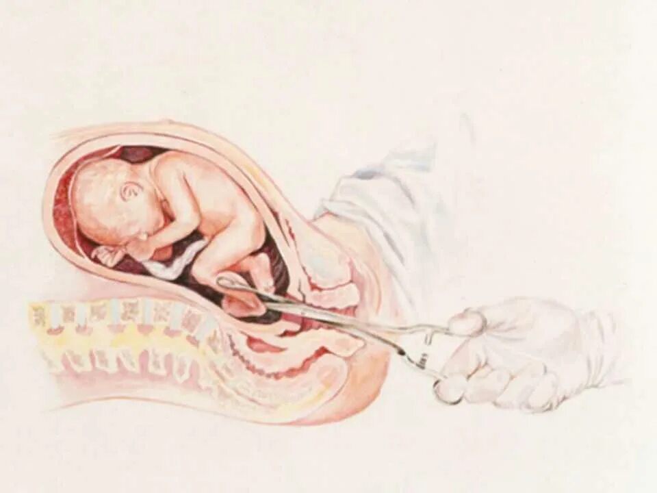 Схватки 3 день. Искусственный аборт методом выскабливания матки. Процесс рождения ребенка.