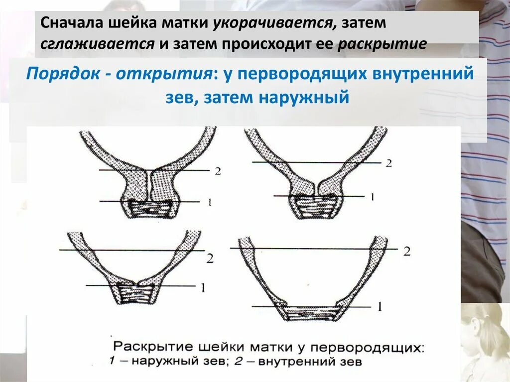 Матка в мм при беременности. Раскрытие шейки матки у первородящих. Раскрытие внутреннего зева. Раскрытие шейки у первородящей.