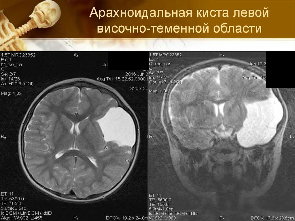 Височная киста головного мозга. Арахноидальная киста левой височной доли мрт. Мрт головного мозга арахноидальная киста левой височной доли. Конвекситальная арахноидальная киста. Арахноидальная ликворная киста лобной доли.