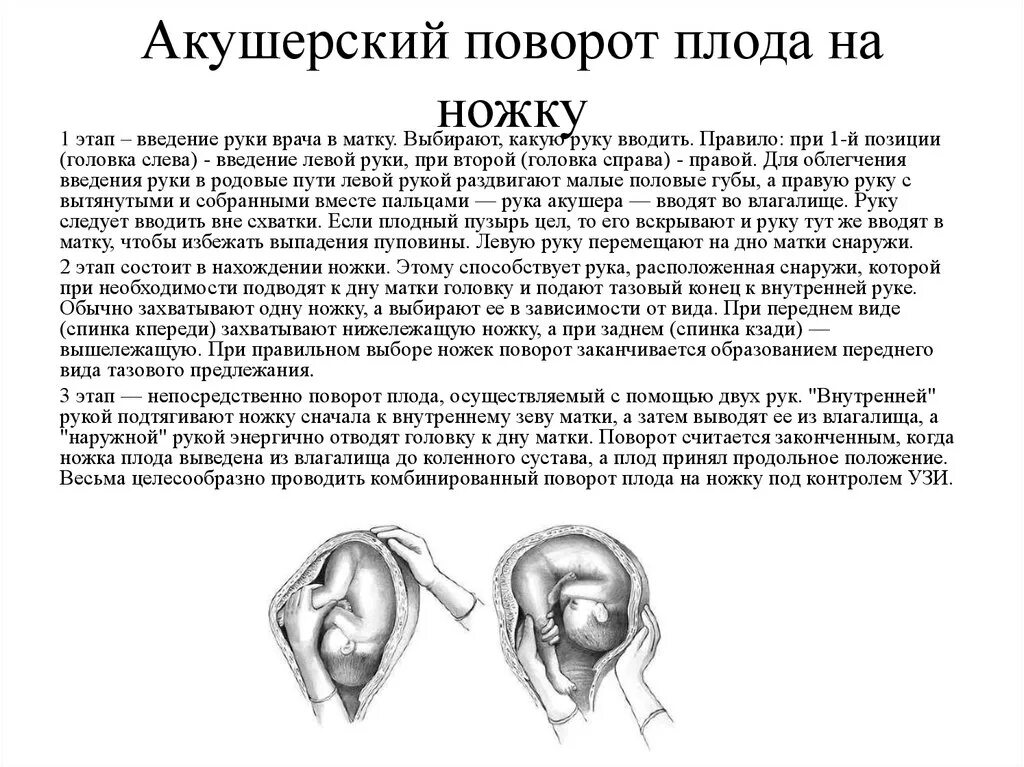 Положение плода акушерское. Наружно-внутренний поворот плода на ножку показания. Разворот плода при тазовом предлежании. Внешний акушерский переворот плода. Поворот плода при поперечном положении.