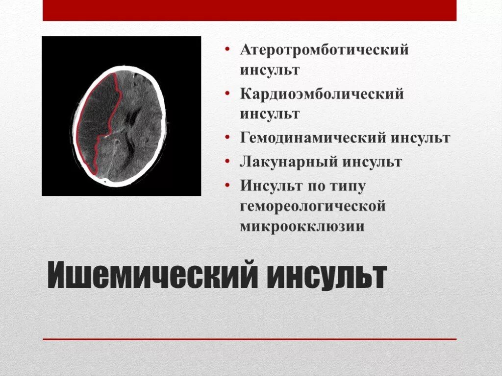 Что такое ишемический инсульт головного мозга. Ишемический инсульт атеротромботический клиника. Ишемический эмболический инсульт. Атеротромботический ишемический инсульт на мрт. Атеротромботический ишемический инсульт кт.