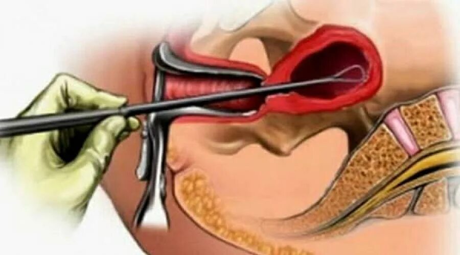 Забеременеть после выскабливания. Пайпель биопсия полости матки. Выскабливание полости матки алгоритм. Лечебно-диагностическое выскабливание полости матки алгоритм. Раздельное диагностическое выскабливание слизистой оболочки матки.