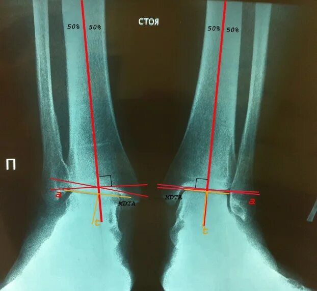 Варусная деформация голеностопного сустава рентген. Варусная деформация коленных суставов рентген. Варусная деформация стоп рентген. Варусная стопа рентген.