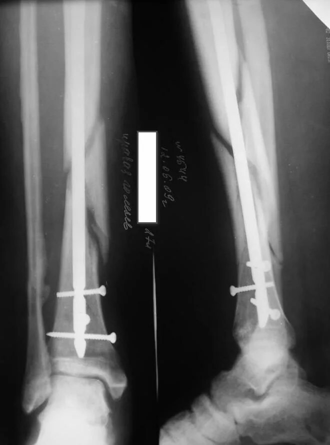 интрамедуллярный остеосинтез большеберцовой кости.