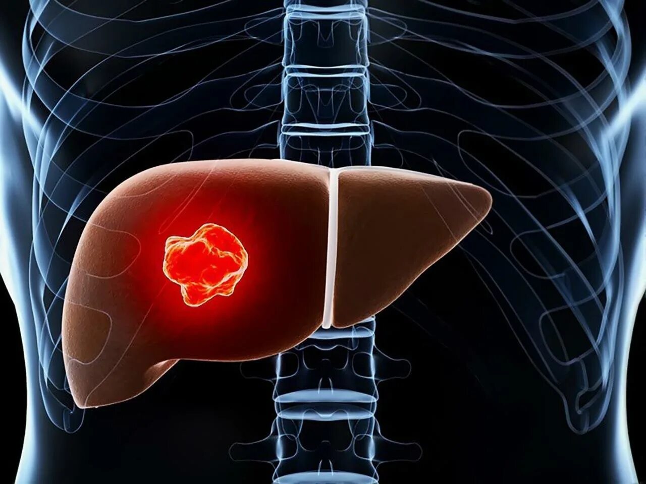 Доброкачественная гемангиома печени. Гемангиома печени (Liver Hemangioma). Раковые поражения печени. Терапия рака печени