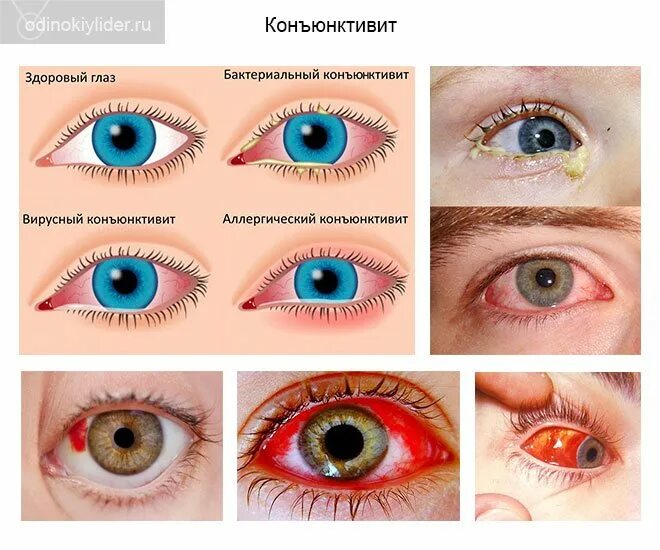 коньюктивит вирусный конъюнктивит и бактериальный конъюнктивит. конъюнктивит симптомы коронавируса. можно ли в школу с коньюктивитом ходить. аллергический конъюнктивит. или быть температура от конъюктивит а.
