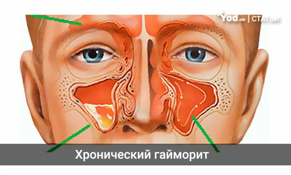 Гнойный насморк у взрослых. Двусторонний катаральный гайморит. Гайморовы пазухи гайморит. Острый катаральный гайморит. Пункция верхнечелюстной пазухи флюс.