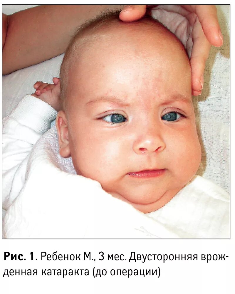 Врожденная катаракта у детей. Катаракта у новорожденных. Катаракта у грудного ребенка. Глаза новорожденного ребенка.