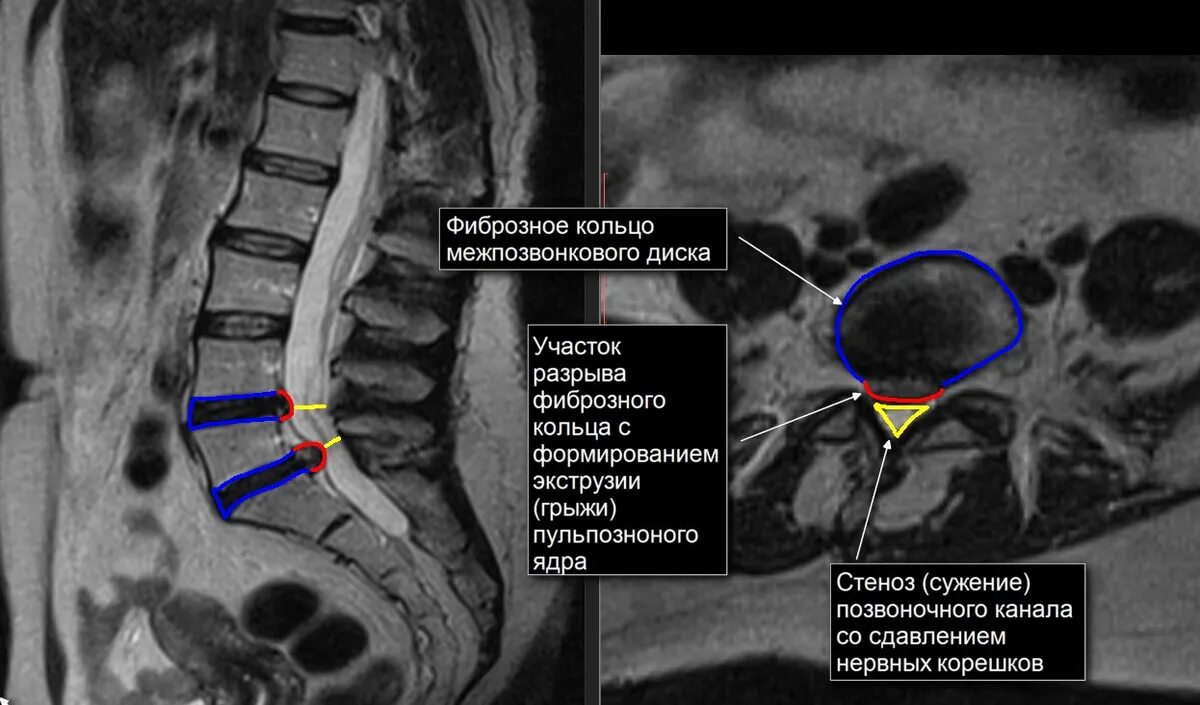 Разрыв диска. Мрт позвоночника пояснично-крестцового отдела (l1-s1). Рентген пояснично-крестцового отдела грыжа. Мрт 1.5 пояснично-крестцового отдела позвоночника. МСКТ пояснично-крестцового отдела позвоночника.