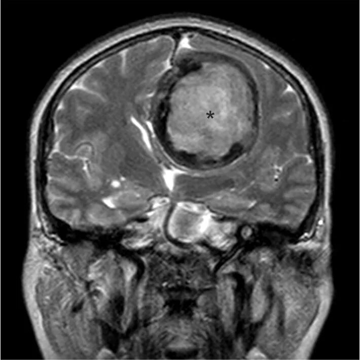 Глиома головного мозга мрт. Тератома головного мозга мрт. Доброкачественная опухоль головного мозга мрт. Доброкачественные глиомы головного мозга мрт. Опухоль в капсуле