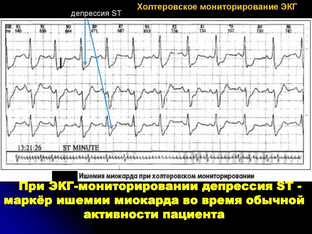 Болезни на экг. Признаки ишемии миокарда на ЭКГ. ЭКГ при субэндокардиальная ишемия. ЭКГ при субэндокардиальной ишемии миокарда. Изменения на ЭКГ при ишемической болезни сердца.