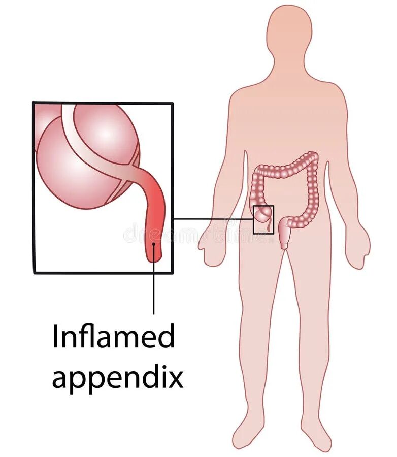 Где аппендикс у человека как болит. Где находится аппендицит. Где находится аппендикс у человека. Гдетнаходится аппендицит.