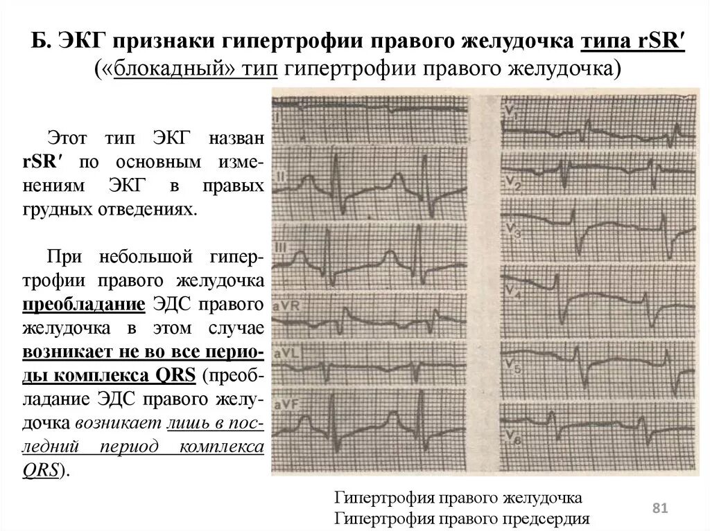 S Тип гипертрофии правого желудочка на ЭКГ. ЭКГ синдром гипертрофии желудочков. Блокадный Тип гипертрофии правого желудочка. Правожелудочковая гипертрофия ЭКГ. Гипертрофия левого предсердия левого желудочка