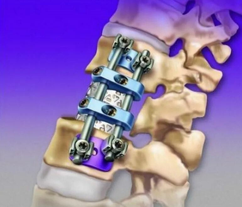 Операция замена дисков позвоночника