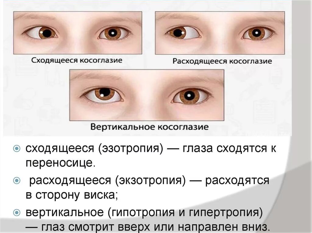 Расходяшие косрюоглазия. Сходящееся косоглазие. Эзотропия сходящееся косоглазие. Косоглазие у детей. Какой глаз левый а какой правый