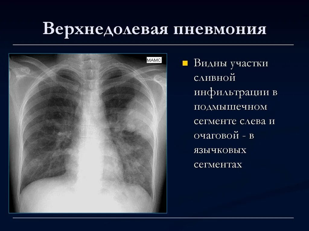 левосторонняя нижнедолевая пневмония рентген. крупозная пневмония верхней доли правого легкого. внебольничная нижнедолевая пневмония. пневмония средней доли рентген. пневмония верхней доли левого легкого рентген.