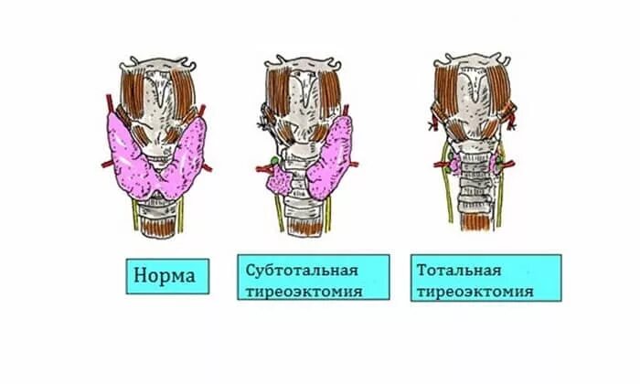 Сколько длится операция щитовидной. Субтотальная резекция щитовидной железы. Энуклеация резекция щитовидной железы. Операция тотальная тиреоидэктомия. Тотальная тиреоидэктомия щитовидной железы.