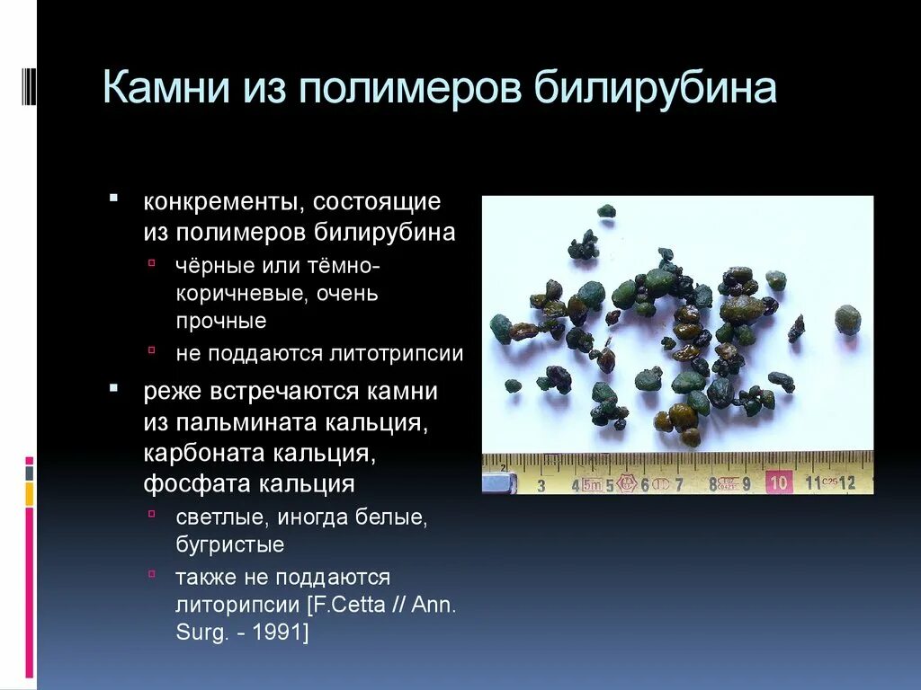 Конкремент латынь. Классификация конкрементов. Конкременты это определение. Конкременты это в медицине кратко.