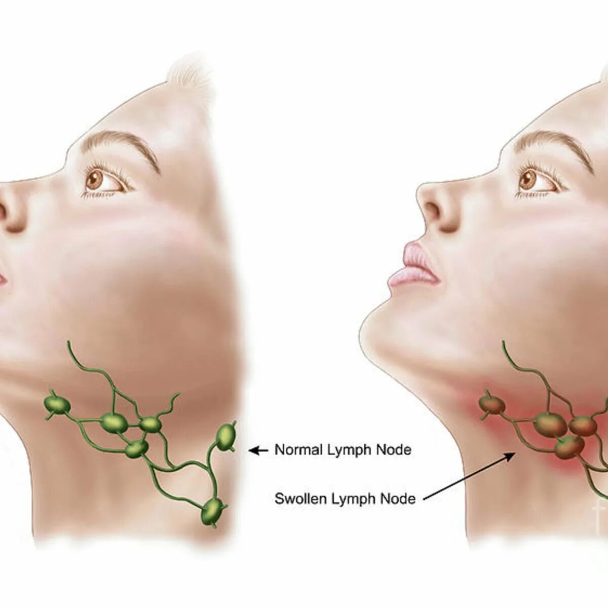 Что значит лимфоузел. Лимфаденит околоушных лимфоузлов. Воспаление лимфатических узлов около челюсти. Воспаленные околоушные лимфоузлы. Тонзиллярные лимфоузлы опухли.