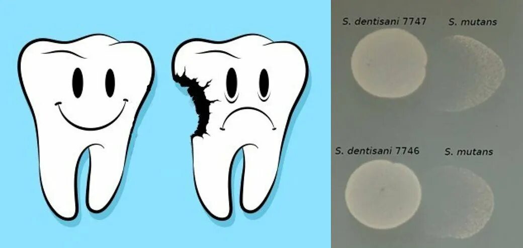 Здоровый и больной зуб. Здоровый зуб и зуб с кариесом. Зуб с кариесом рисунок. Неприятное ощущение на зубах