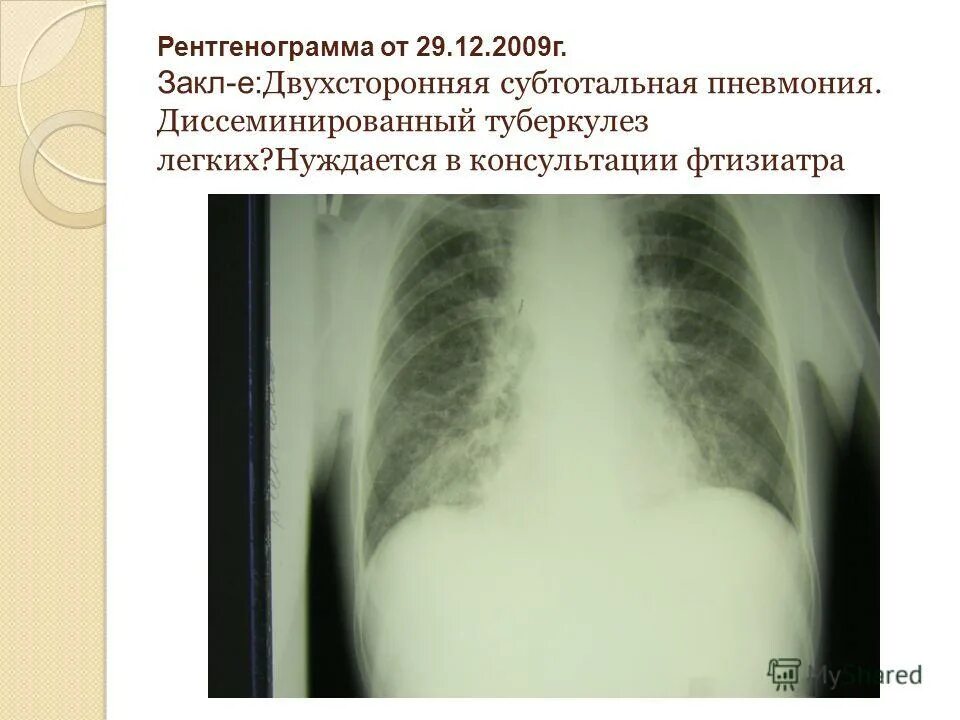Клинический случай туберкулез. Субтотальное затемнение пневмония рентген. Субтотальная пневмония рентген. Тотальная и субтотальная пневмония.