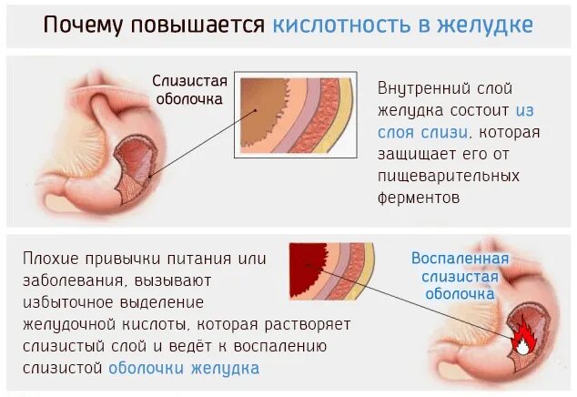 Симптомы повышенной кислотности желудка. Повышение кислотности желудка симптомы. Повышенная кислотность желудка причины. Повышенное кислотообразование в желудке. Отчего поднимается