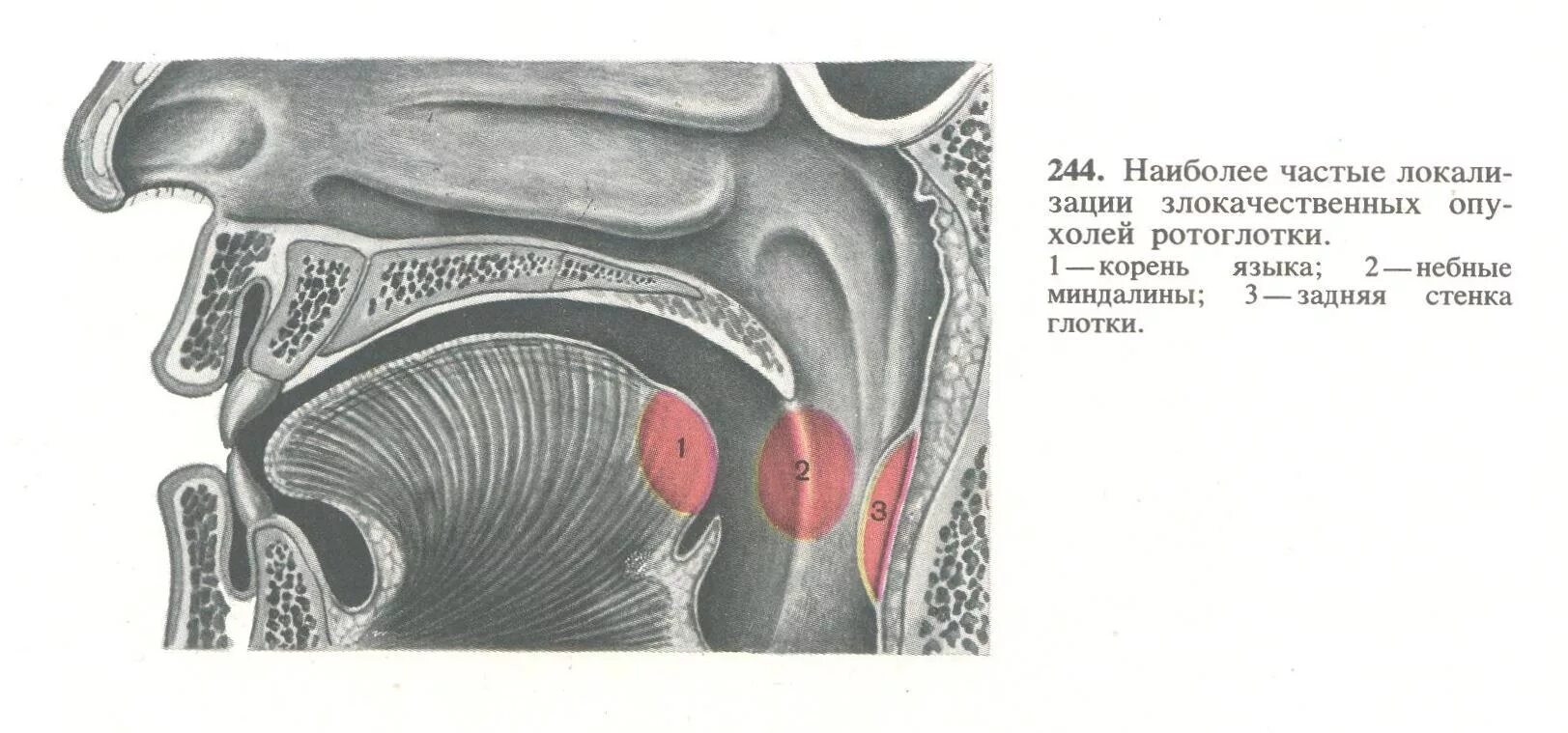 Злокачественные опухоли ротоглотки. Небные миндалины анатомия кт.