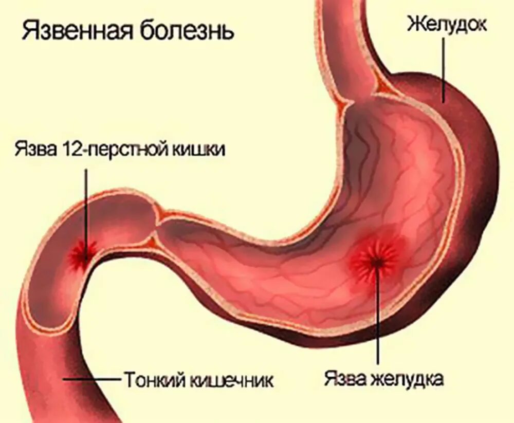 Лечение язвы желудка и 12 перстной. Язвенная болезнь желудка и 12 перстной. Язва желудка и 12 перстной кишки. Язвенная болезнь болезнь желудка и 12 перстной кишки. Язвенная болезнь 12 перстной кишки.