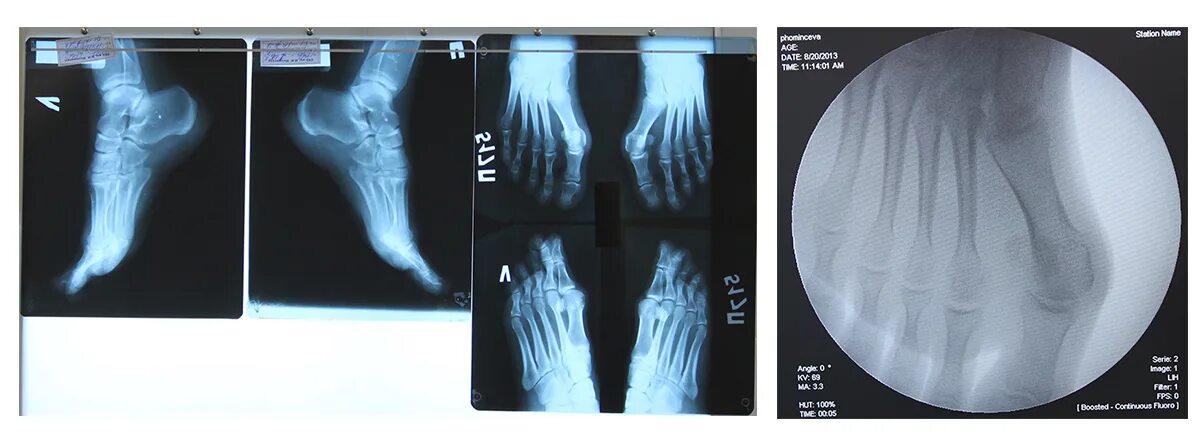 рентген стоп стоя. поперечное плоскостопие рентген укладка. продольно поперечное плоскостопие рентген. остеосаркома стопы рентген. рентген стоп стоя.